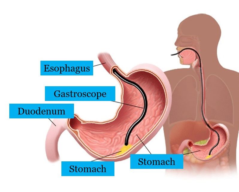 Gastroscopy Endoscopy Maher A Abbas MD Proctology Colonoscopy