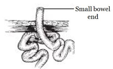 Ileostomy Care - Maher A. Abbas, MD, Proctologist, Colorectal Surgeon