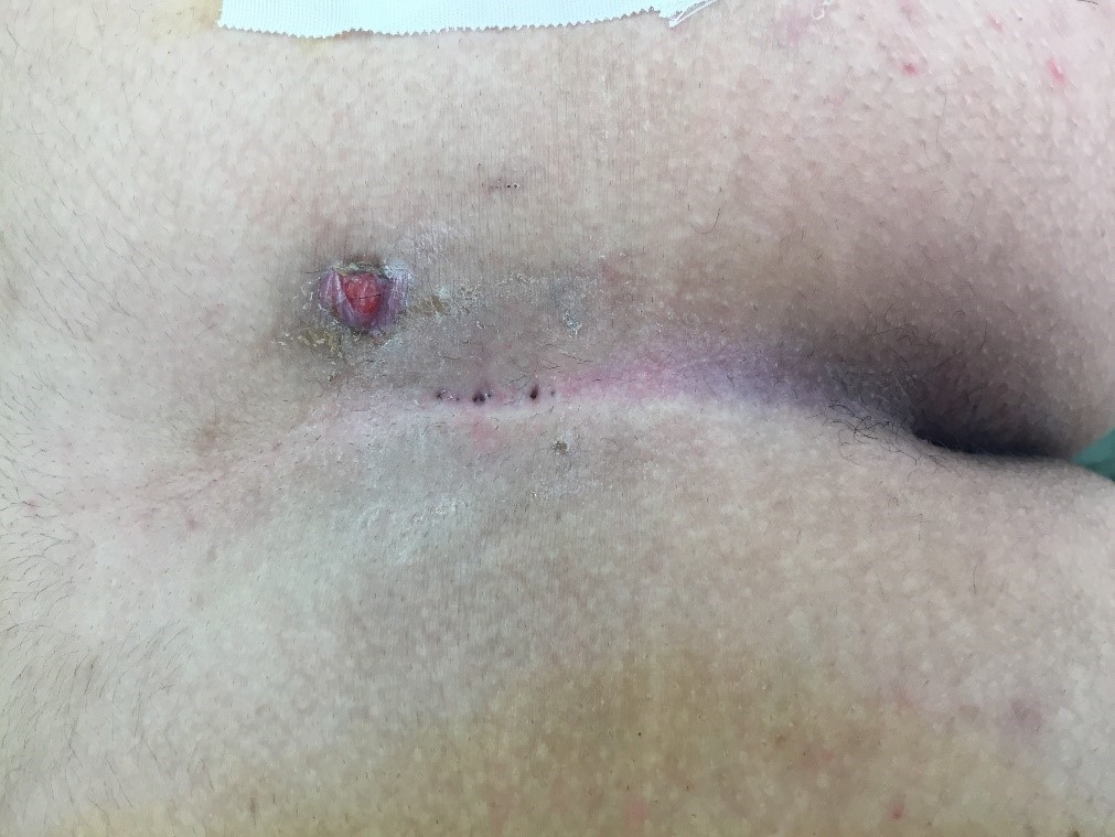 https://drmaherabbas.com/wp-content/uploads/2018/03/pilonidal-wound-care-2.jpg