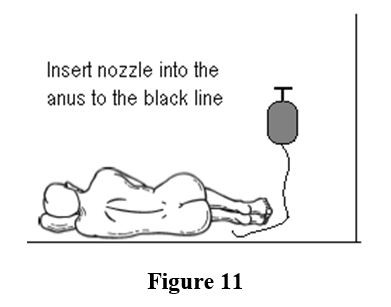 Rectal irrigation - Insert nozzle into the anus