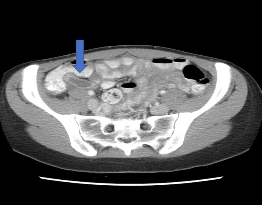 Appendix Tumors - Maher A. Abbas, MD, Proctologist, Colorectal Surgeon