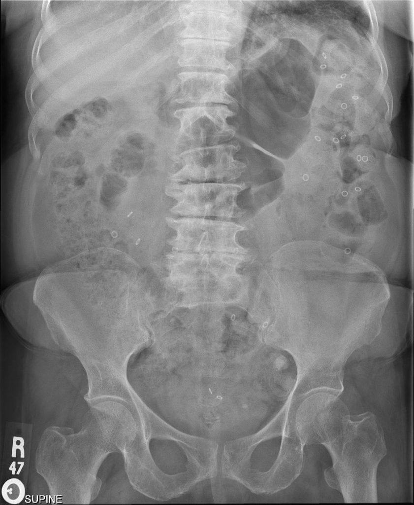 Constipation - Maher A. Abbas, MD, proctologist, colorectal surgeon