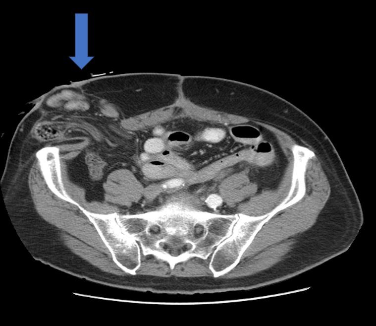 Parastomal Hernia - Maher A. Abbas, MD, proctologist, colorectal surgeon