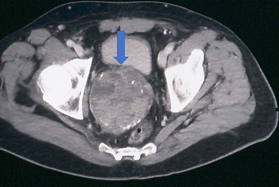 abdominal-and-pelvic-tumors-maher-a-abbas-md-dubai-uae