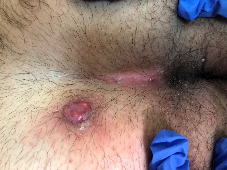 Pilonidal Disease And Skin Disorders Maher A Abbas Md Dubai Uae