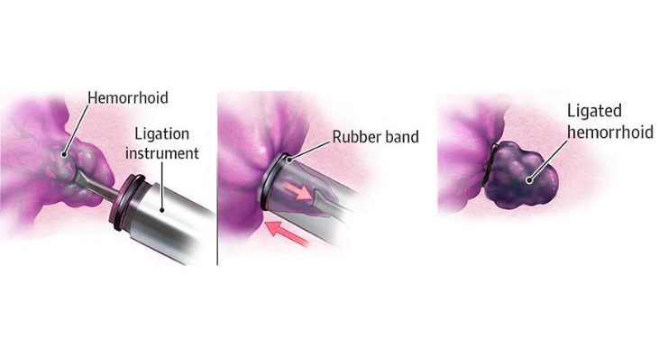 Injectie versieren verhaal Minimally Invasive Procedures for Hemorrhoids - Maher A. Abbas, MD | UAE