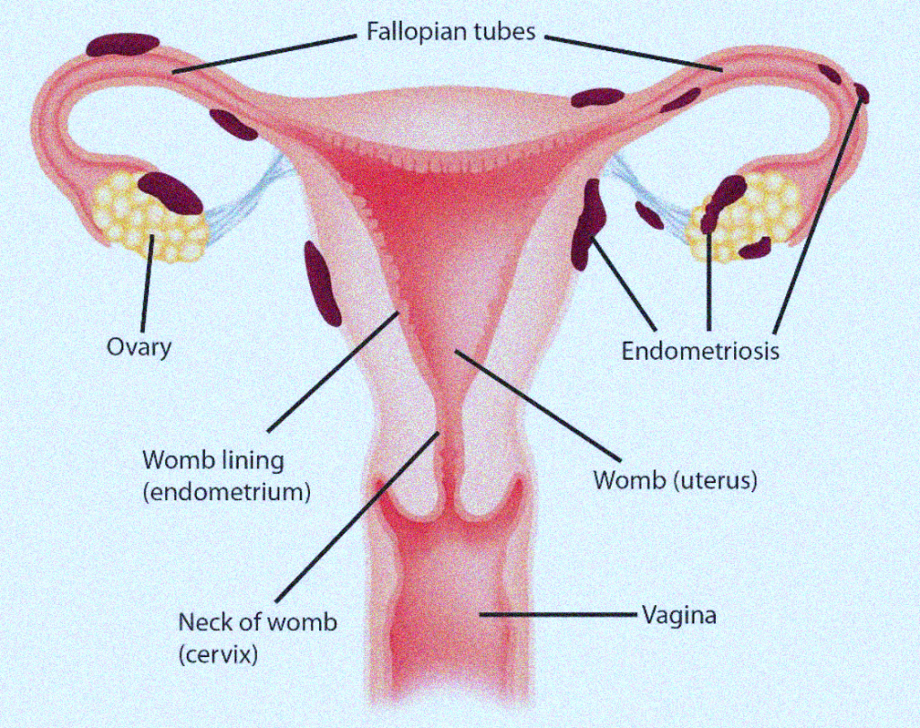 Endometriosis - Maher A. Abbas, MD