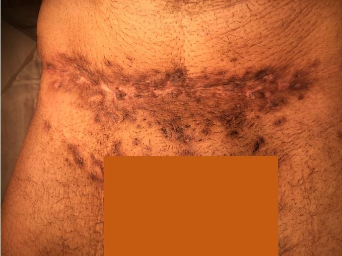 Hidradenitis Suppurativa Maher A Abbas Md Hidradenitis Suppurativa Maher A Abbas Md