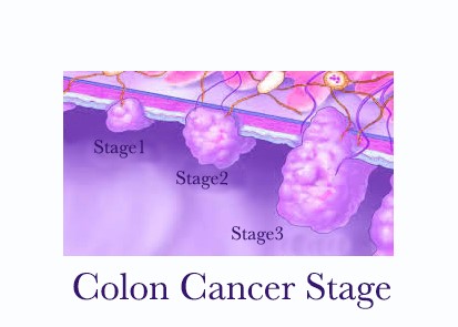 Colon Cancer - Maher A. Abbas, MD, proctologist, colorectal surgeon